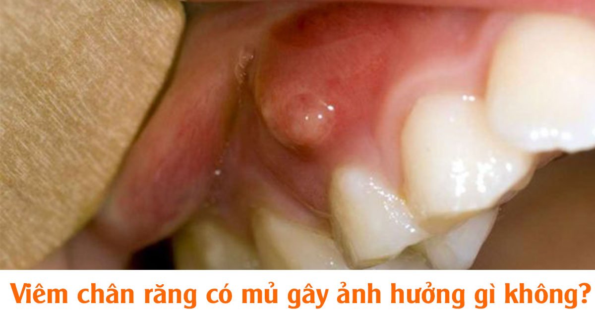 Viêm chân răng có mủ gây ảnh hưởng gì không?