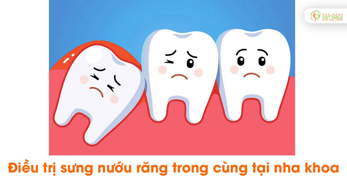 Điều trị sưng nướu răng trong cùng tại nha khoa