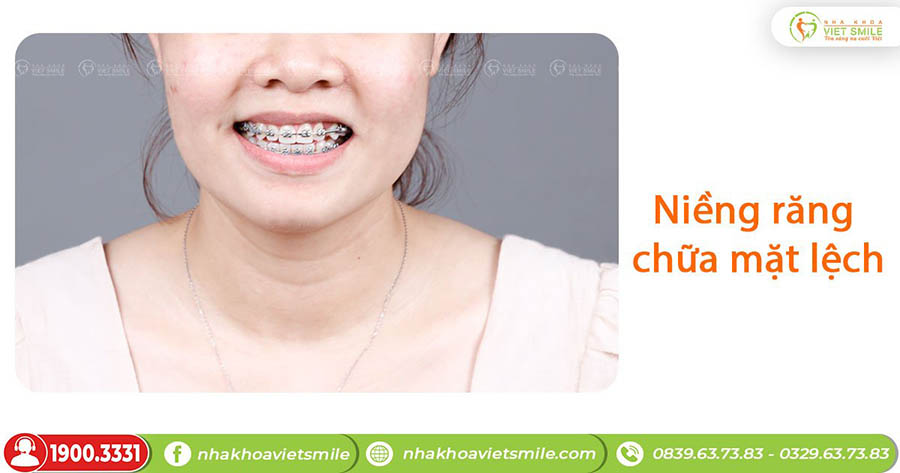 Nắn chỉnh răng với phương pháp niềng răng