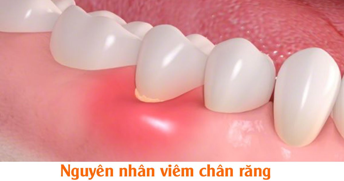 Nguyên nhân viêm chân răng
