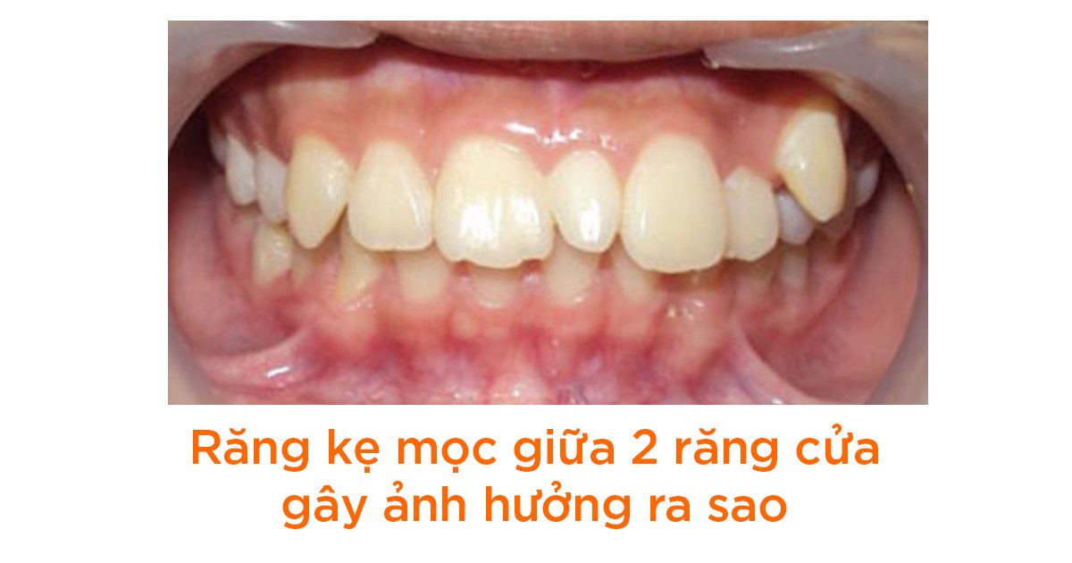 Răng kẹ mọc giữa 2 răng cửa gây ra ảnh hưởng gì?