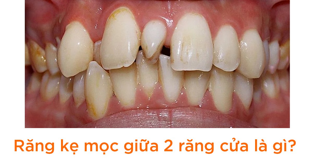 Răng kẹ mọc giữa 2 răng cửa là gì?