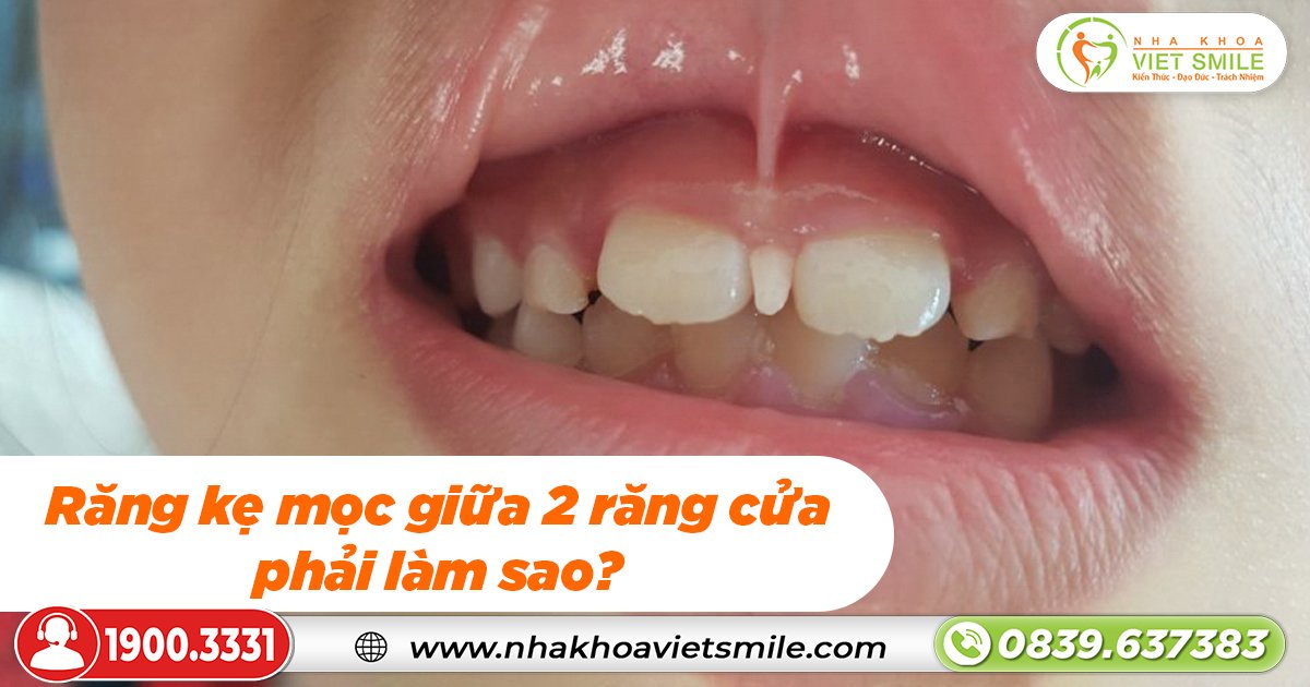 Răng kẹ mọc giữa 2 răng cửa phải làm sao?