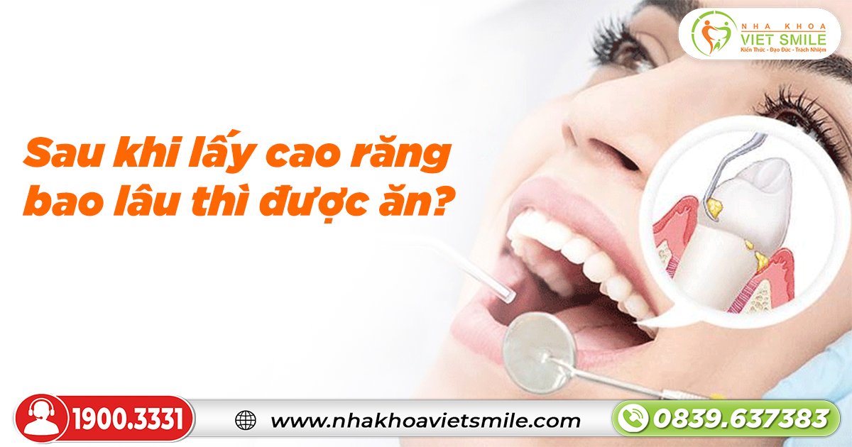 Sau khi lấy cao răng bao lâu thì được ăn?