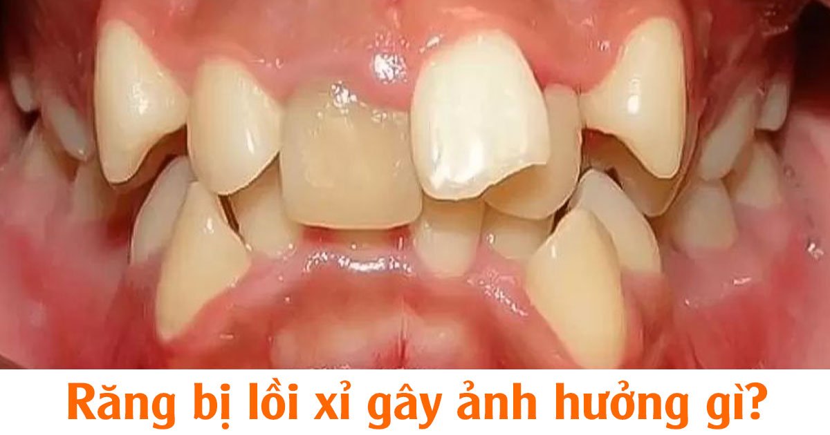 Răng bị lồi xỉ gây ảnh hưởng gì?