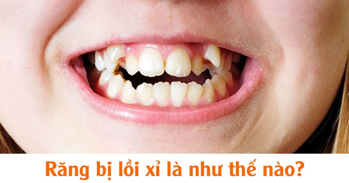 Răng bị lồi xỉ là như thế nào?