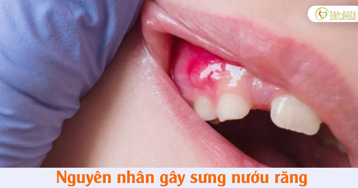 Nguyên nhân gây sưng nướu răng