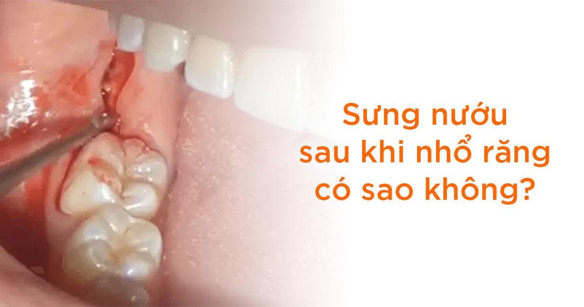 Sưng nướu sau khi nhổ răng có sao không?