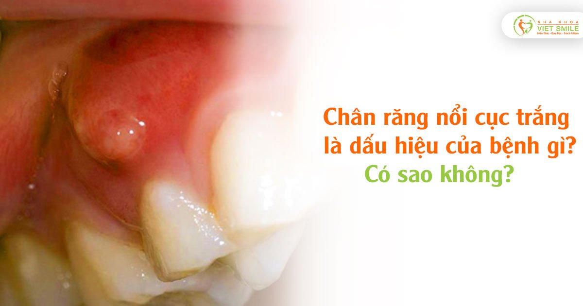 Chân răng nổi cục trắng là dấu hiệu của bệnh gì? Có sao không?