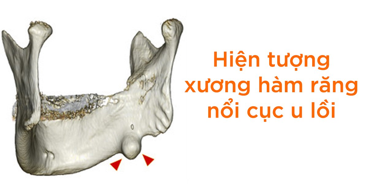 Hiện tượng xương hàm răng nổi cục u lồi