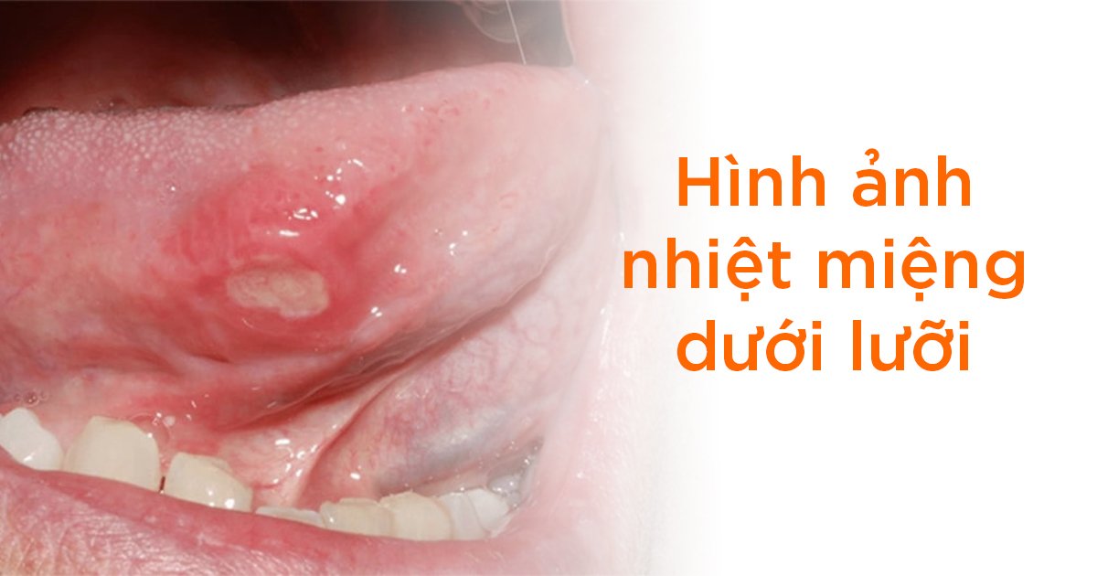 Nổi mụn dưới lưới và hình thành nhiệt miệng