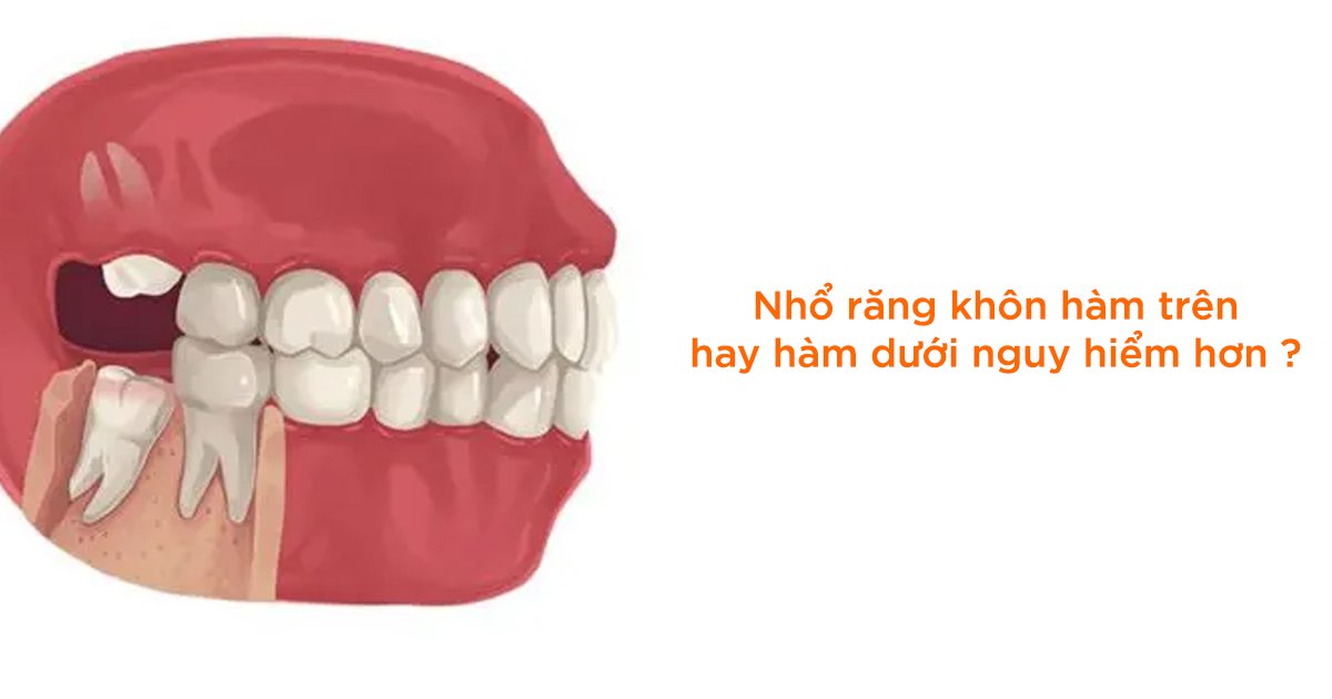Nhổ răng khôn hàm trên hay hàm dưới nguy hiểm hơn?