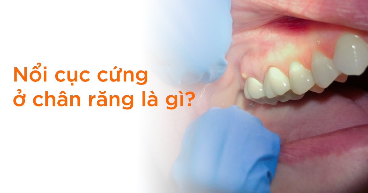 Nổi cục cứng ở chân răng là gì?