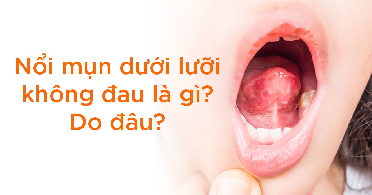 Nổi mụn dưới lưỡi không đau là gì? Do đâu?