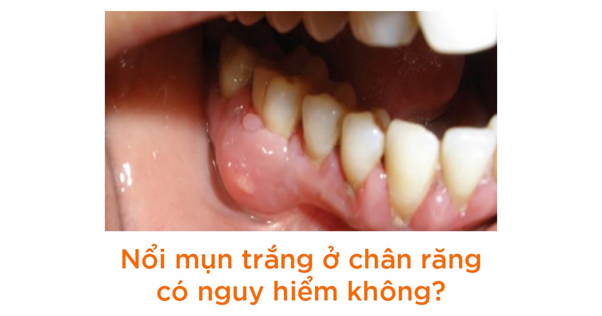 Nổi mụn trắng ở chân răng có nguy hiểm không?