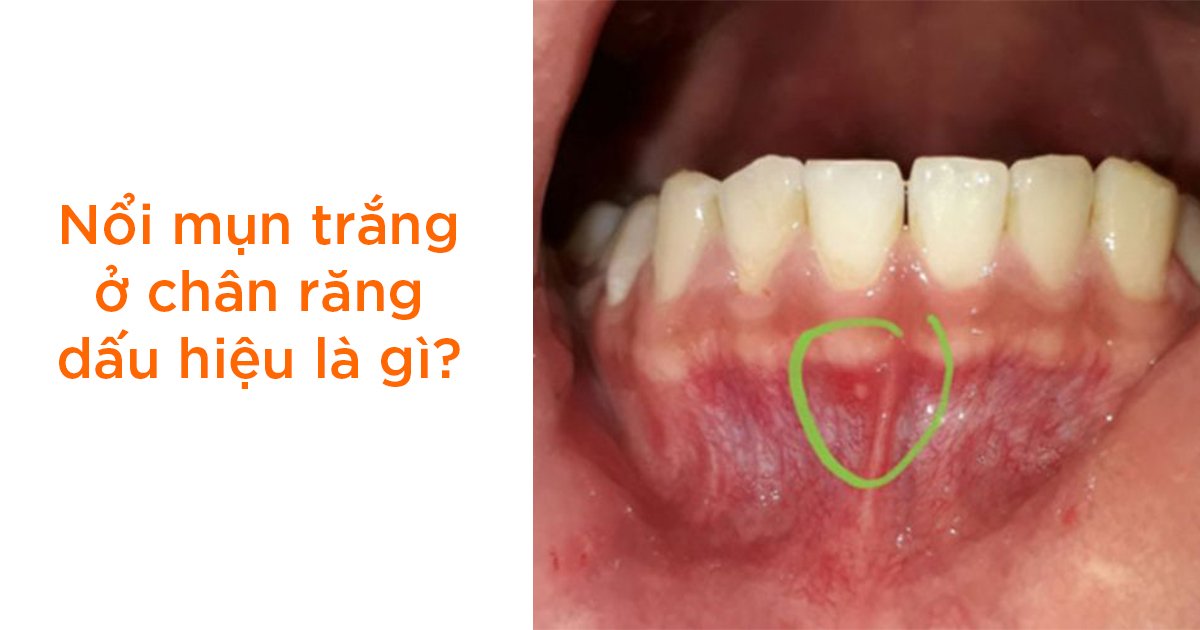 Nổi mụn trắng ở chân răng dấu hiệu là gì?