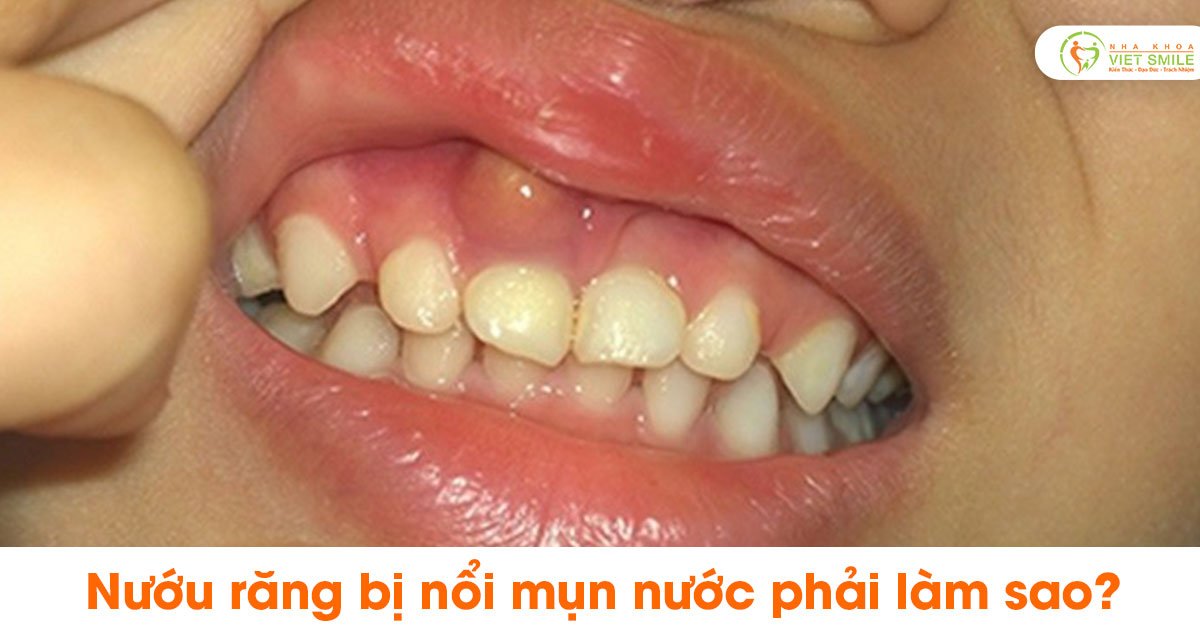 Nướu răng bị nổi mụn nước phải làm sao?