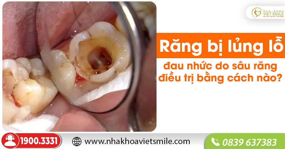Răng bị lủng lỗ đau nhức do sâu răng điều trị bằng cách nào?