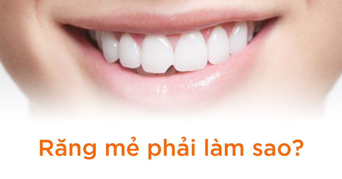 Răng mẻ phải làm sao?