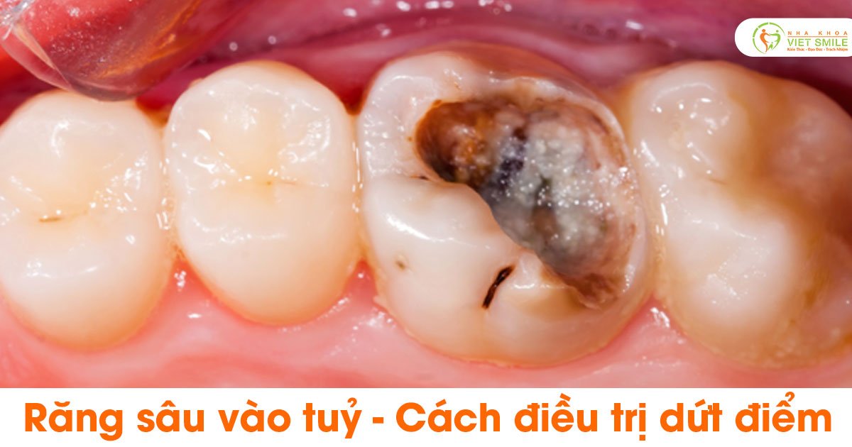 Răng sâu vào tuỷ - cách điều trị dứt điểm