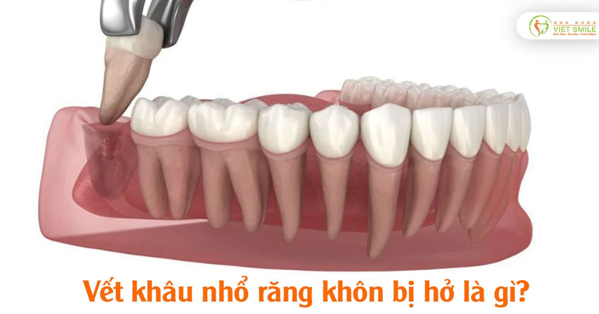 Vết khâu nhổ răng khôn bị hở là gì?