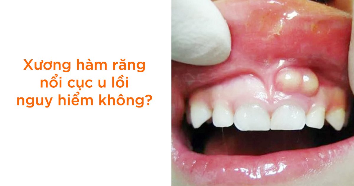 Xương hàm răng nổi cục u lồi nguy hiểm không?