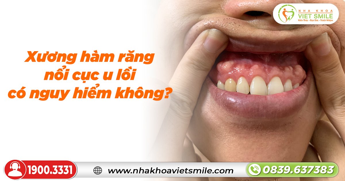 Xương hàm răng nổi cục u lồi có nguy hiểm không?
