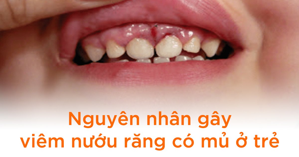 Nguyên nhân gây viêm nướu răng có mủ ở trẻ