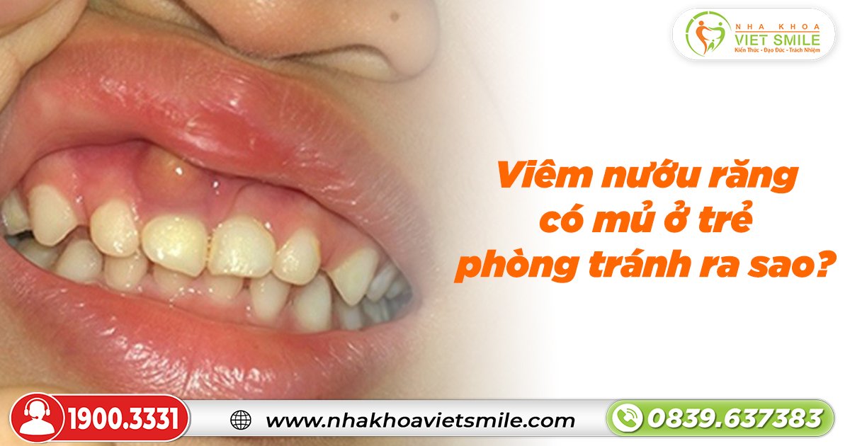 Viêm nướu răng có mủ ở trẻ phòng tránh ra sao?