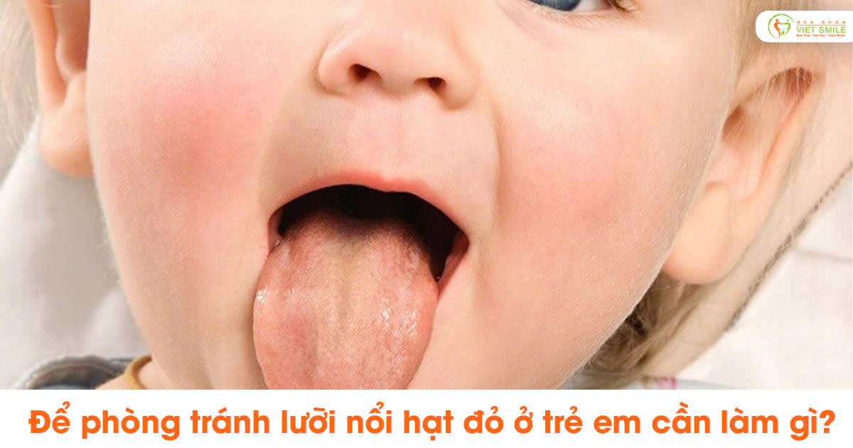 Để phòng tránh lưỡi nổi hạt đỏ ở trẻ em cần làm gì?