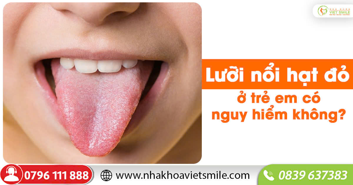 Lưỡi nổi hạt đỏ ở trẻ em có nguy hiểm không?