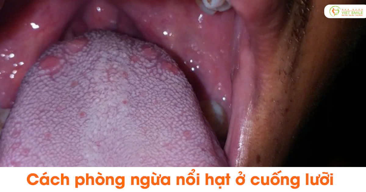 Cách phòng ngừa nổi hạt ở cuống lưỡi