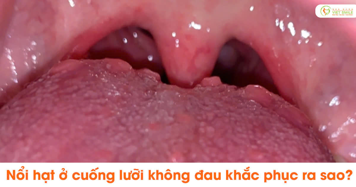 Nổi hạt ở cuống lưỡi không đau khắc phục ra sao?