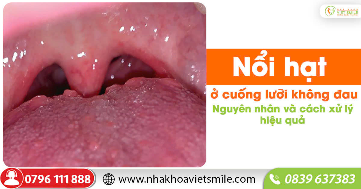 Nổi hạt ở cuống lưỡi không đau: Nguyên nhân và cách xử lý hiệu quả