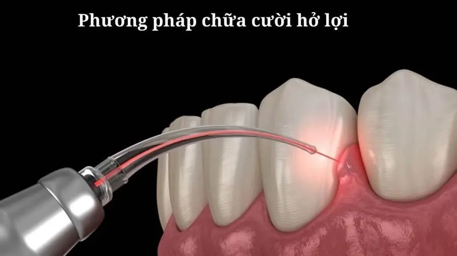 Chữa cười hở lợi bằng laser