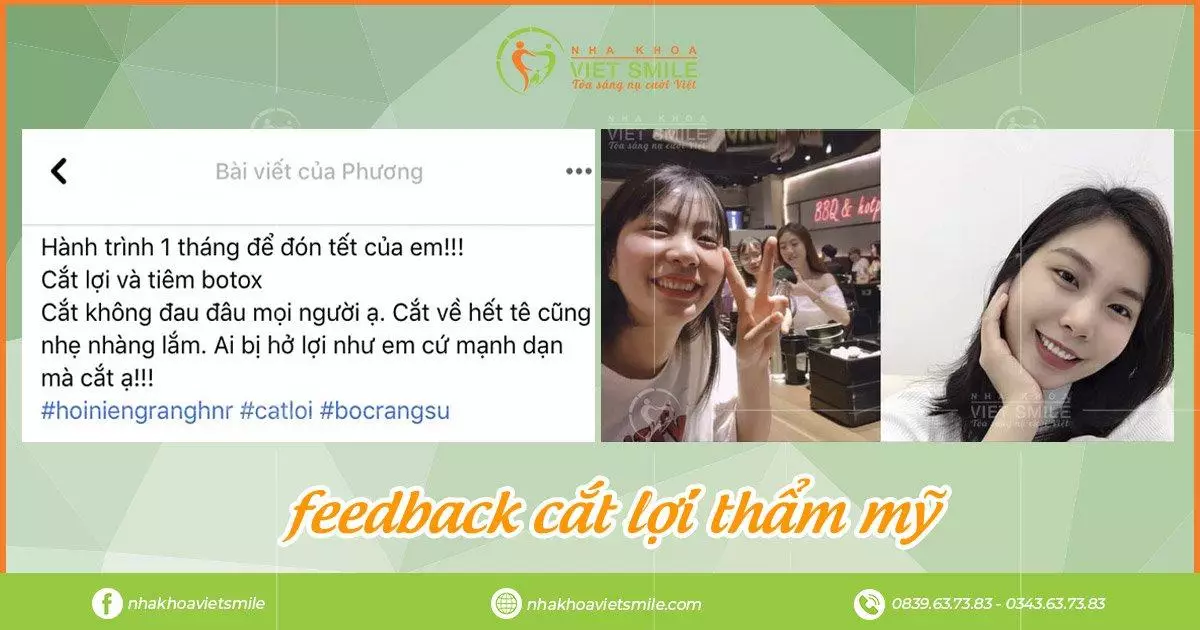 VietSmile Trị Cười Hở Lợi