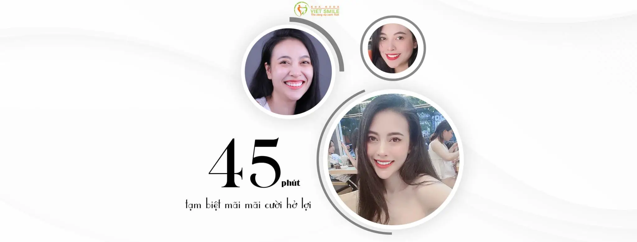 Cười hở lợi