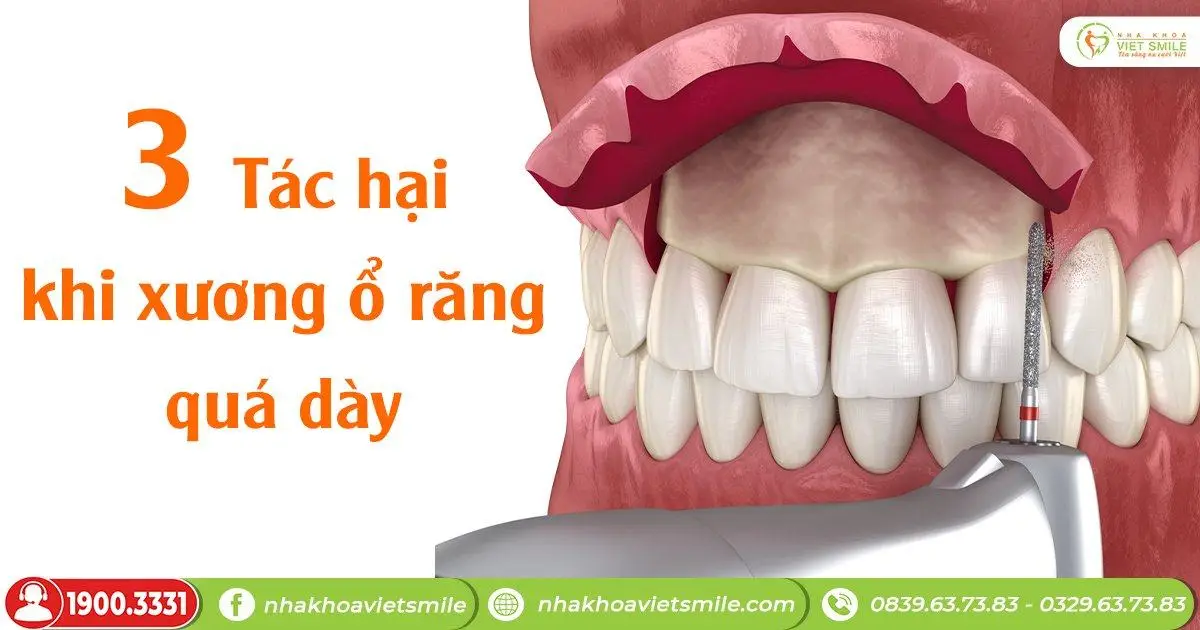 3 Tác hại khi xương ổ răng quá dày