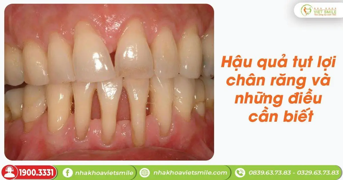Hậu quả tụt lợi chân răng và những điều cần biết