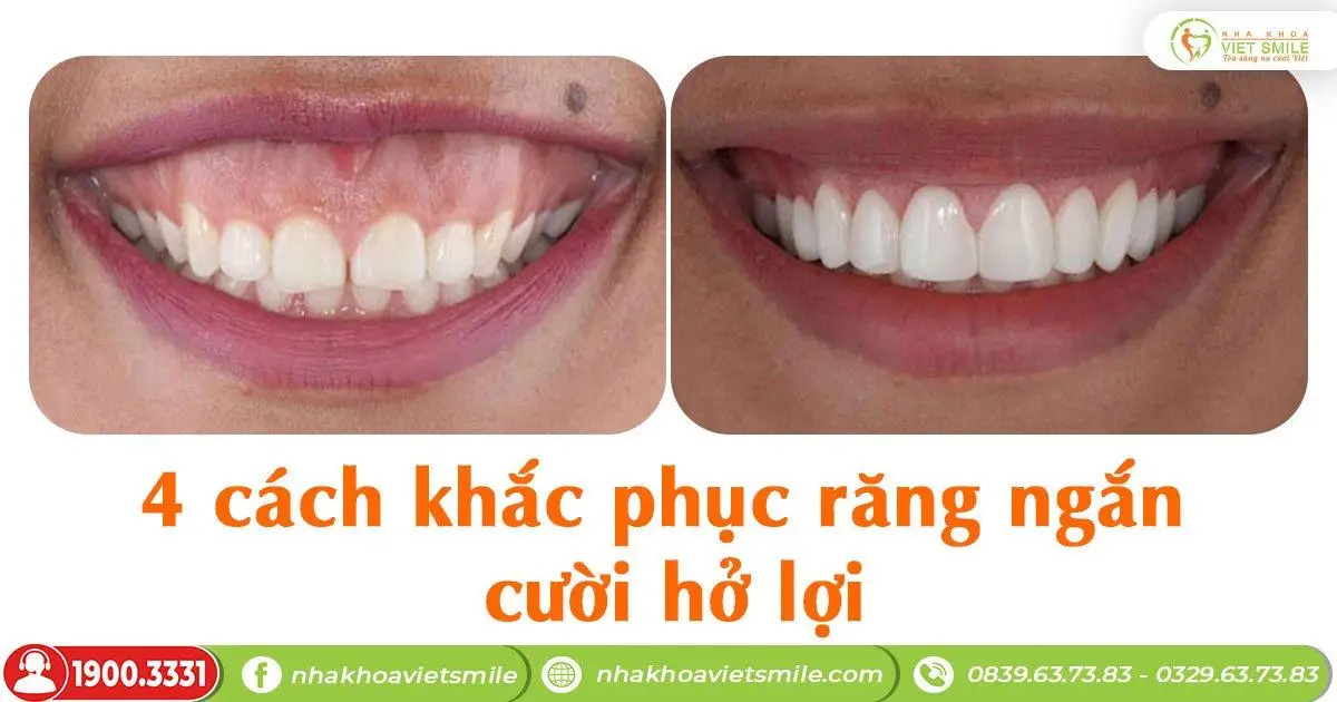 Răng ngắn cười hở lợi