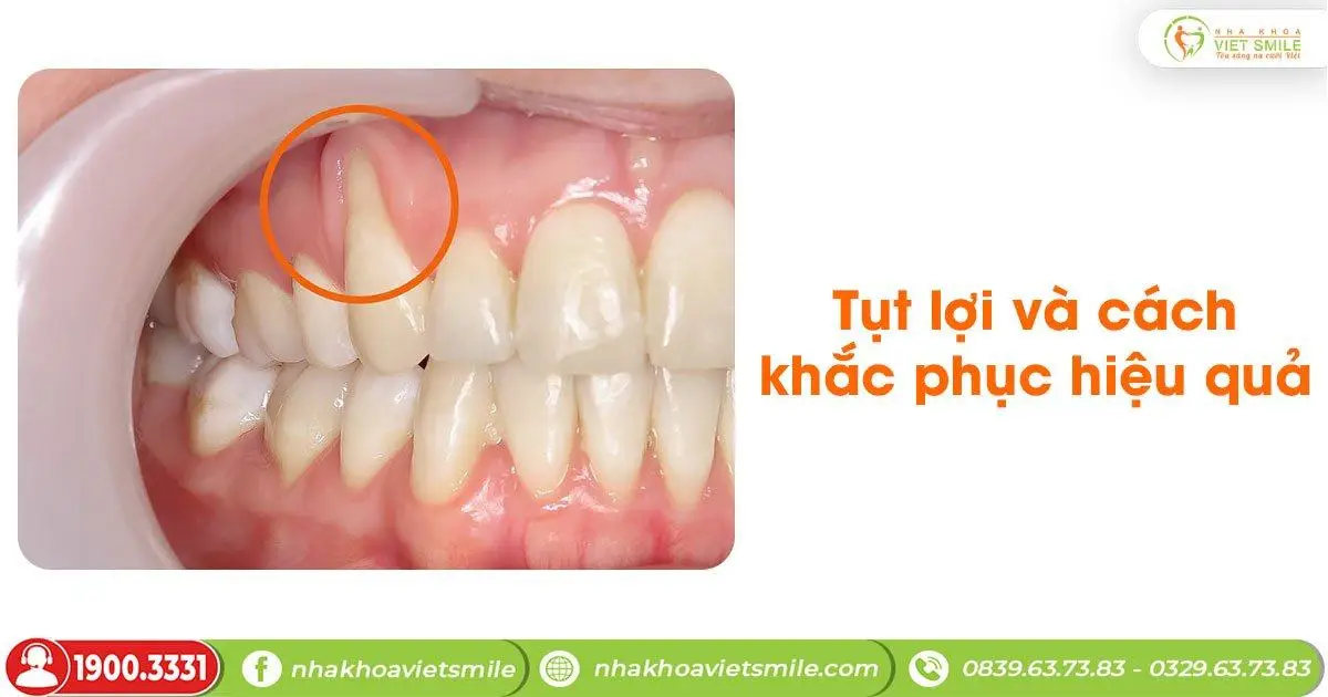 Tụt lợi và cách khắc phục hiệu quả