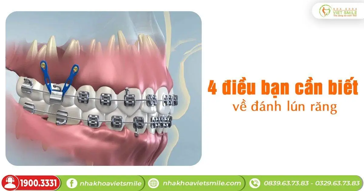 4 điều bạn cần biết về đánh lún răng