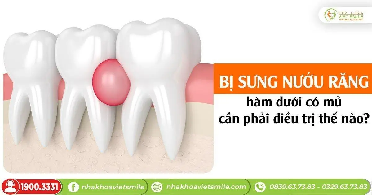 Bị sưng nướu răng hàm dưới có mủ cần phải điều trị thế nào?