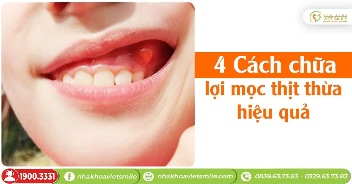 4 Cách chữa lợi mọc thịt thừa hiệu quả