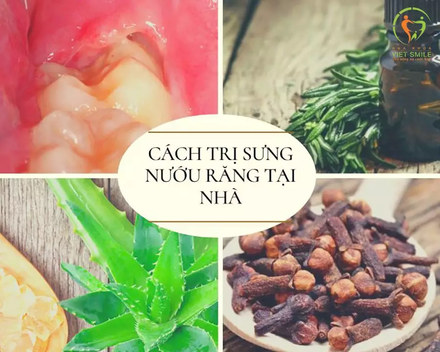 Cách chữa viêm lợi bằng dân gian cực hiệu quả
