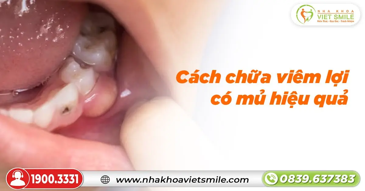 Cách chữa viêm lợi có mủ hiệu quả?