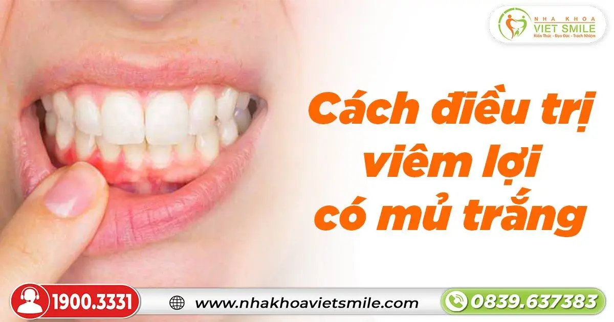Cách điều trị viêm lợi có mủ trắng