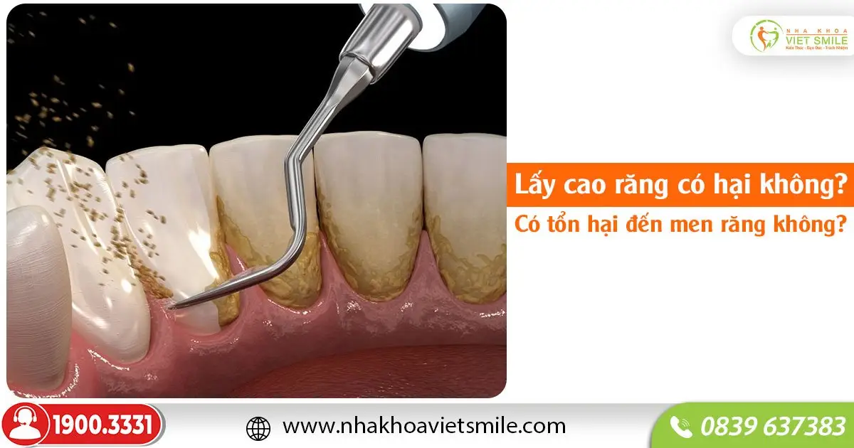 Lấy cao răng có hại không? Có tổn hại đến men răng không?