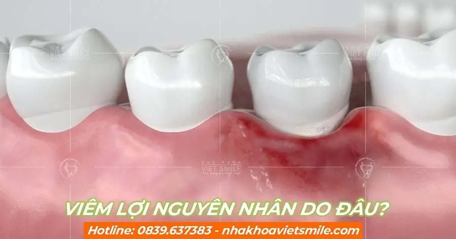 Nguyên nhân viêm lợi răng