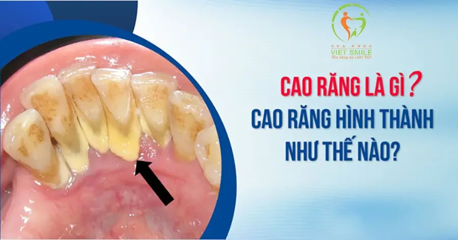 Cao răng là gì? Cao răng hình thành như thế nào?